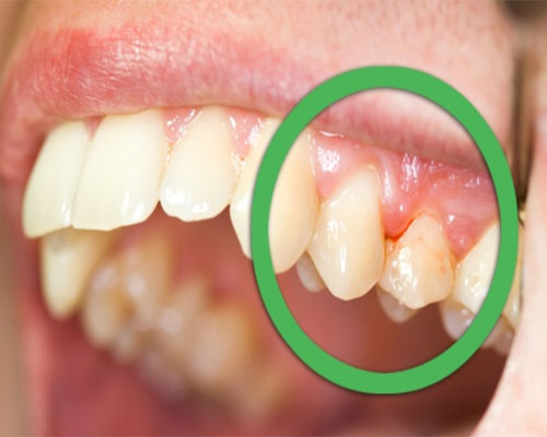 7 Early Signs Your Gums Are in Trouble