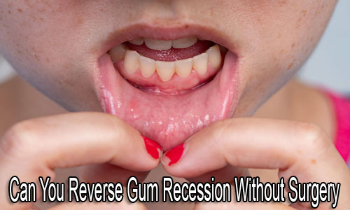 Can You Reverse Gum Recession Without Surgery