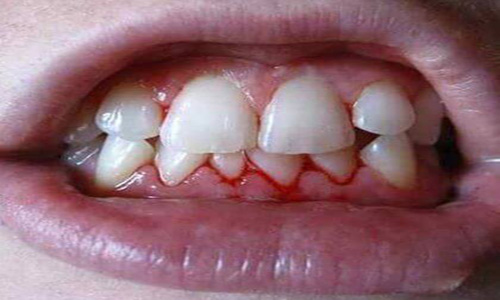 Home Remedies for Gum Bleeding and Swelling