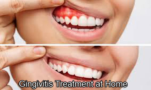 Gingivitis Treatment at Home
