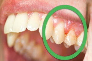 7 Early Signs Your Gums Are in Trouble