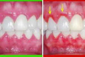 Fastest Way to Heal Swollen Gums