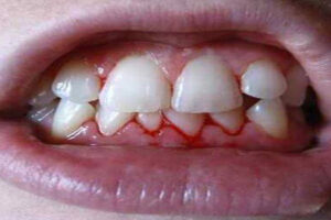 Home Remedies for Gum Bleeding and Swelling