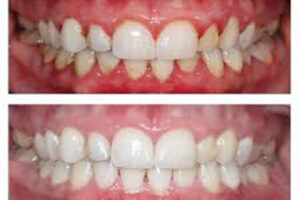 How to Get Your Gums Healthy