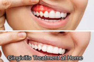 Gingivitis Treatment at Home
